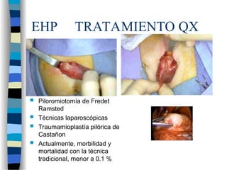 EHP TRATAMIENTO QX
 Piloromiotomía de Fredet
Ramsted
 Técnicas laparoscópicas
 Traumamioplastía pilórica de
Castañon
 Actualmente, morbilidad y
mortalidad con la técnica
tradicional, menor a 0.1 %
 