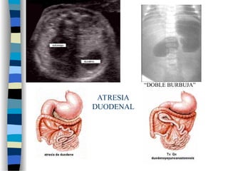 ATRESIA
DUODENAL
“DOBLE BURBUJA”
 