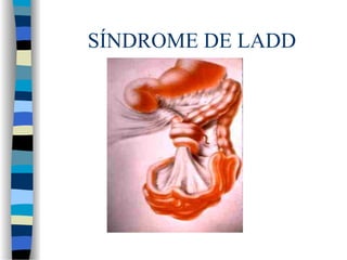 SÍNDROME DE LADD
 