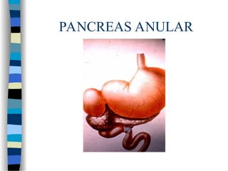 PANCREAS ANULAR
 