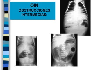  OIN
OBSTRUCCIONES
INTERMEDIAS:
 