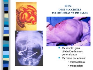 OIN.
OBSTRUCCIONES
INTERMEDIAS VS DISTALES
 Rx simple: gran
dilatación de asas,
generalizada
 Rx colon por enema:
• microcolon o
• megacolon
 