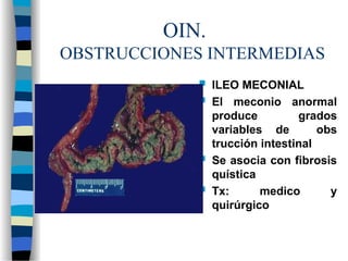 OIN.
OBSTRUCCIONES INTERMEDIAS
 ILEO MECONIAL
 El meconio anormal
produce grados
variables de obs
trucción intestinal
 Se asocia con fibrosis
quística
 Tx: medico y
quirúrgico
 