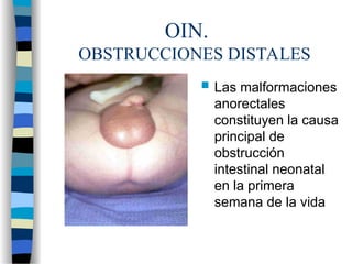 OIN.
OBSTRUCCIONES DISTALES
 Las malformaciones
anorectales
constituyen la causa
principal de
obstrucción
intestinal neonatal
en la primera
semana de la vida
 