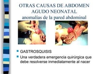 OTRAS CAUSAS DE ABDOMEN
AGUDO NEONATAL
anomalías de la pared abdominal
 GASTROSQUISIS
 Una verdadera emergencia quirúrgica que
debe resolverse inmediatamente al nacer
 