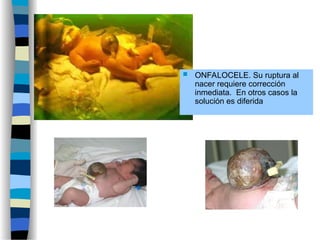  ONFALOCELE. Su ruptura al
nacer requiere corrección
inmediata. En otros casos la
solución es diferida
 