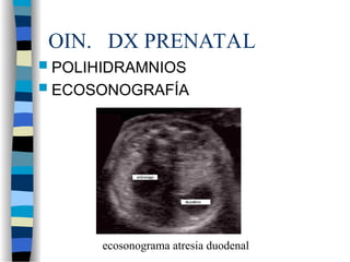 OIN. DX PRENATAL
 POLIHIDRAMNIOS
 ECOSONOGRAFÍA
ecosonograma atresia duodenal
 
