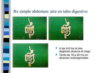 Rx simple abdomen: aire en tubo digestivo
 A las 4-6 hrs el aire
deglutido alcanza el ciego
 Tarda de 18 a 24 hrs en
alcanzar rectosigmoides
 