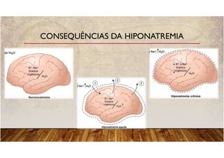 CONSEQUÊNCIAS DA HIPONATREMIA
 