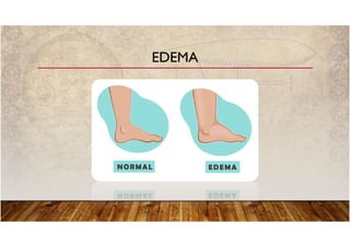 EDEMA
 