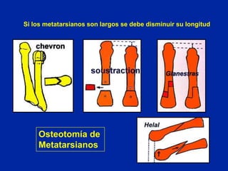 Si los metatarsianos son largos se debe disminuir su longitud

Osteotomía de
Metatarsianos

 
