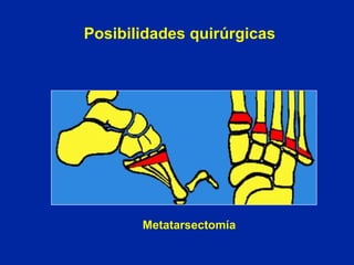 Metatarsectomía
Posibilidades quirúrgicas
 