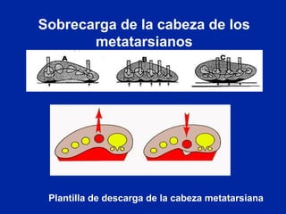 Sobrecarga de la cabeza de los
metatarsianos
Plantilla de descarga de la cabeza metatarsiana
 
