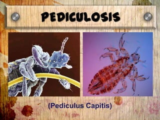 PEDICULOSIS




(Pediculus Capitis)
 
