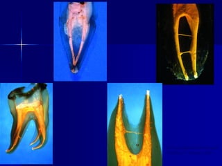 Pulp Space Injection 01-pulp space morphology 3rd yegfhfar.pdf