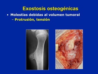 • Molestias debidas al volumen tumoral
– Protrusión, tensión
Exostosis osteogénicasExostosis osteogénicas
 