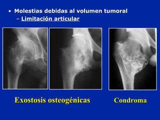 • Molestias debidas al volumen tumoral
– Limitación articular
Exostosis osteogénicasExostosis osteogénicas CondromaCondroma
 