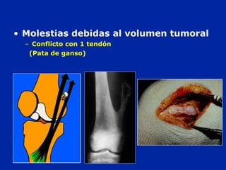 • Molestias debidas al volumen tumoral
– Conflicto con 1 tendón
(Pata de ganso)
 