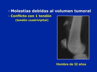 – Molestias debidas al volumen tumoral
– Conflicto con 1 tendón
(tendón cuadricipital)
Hombre de 32 años
 