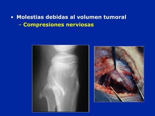 • Molestias debidas al volumen tumoral
– Compresiones nerviosas
 