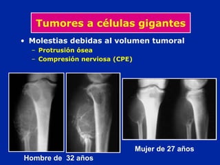 Mujer de 27 años
Hombre de 32 años
Tumores a células gigantes
• Molestias debidas al volumen tumoral
– Protrusión ósea
– Compresión nerviosa (CPE)
 