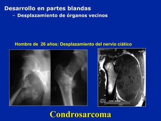 CondrosarcomaCondrosarcoma
Hombre de 26 años: Desplazamiento del nervio ciático
Desarrollo en partes blandas
– Desplazamiento de órganos vecinos
 