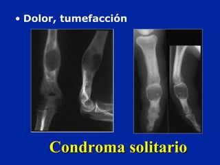 Condroma solitarioCondroma solitario
• Dolor, tumefacción
 