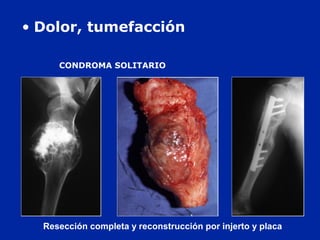 Resección completa y reconstrucción por injerto y placa
CONDROMA SOLITARIO
• Dolor, tumefacción
 