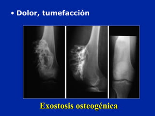 Exostosis osteogénicaExostosis osteogénica
• Dolor, tumefacción
 