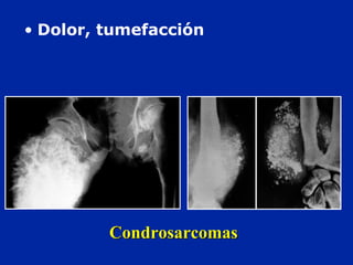 CondrosarcomasCondrosarcomas
• Dolor, tumefacción
 
