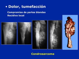 Compromiso de partes blandas
Recidiva local
Condrosarcoma
• Dolor, tumefacción
 