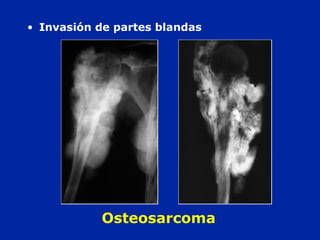 Osteosarcoma
• Invasión de partes blandas
 