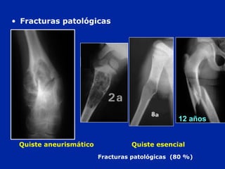 Fracturas patológicas (80 %)
Quiste aneurismático Quiste esencial
• Fracturas patológicas
12 ans12 años
 