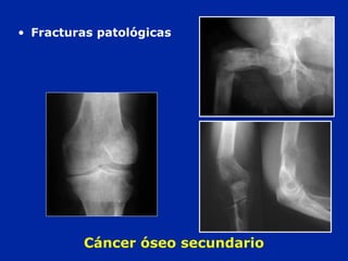 Cáncer óseo secundario
• Fracturas patológicas
 