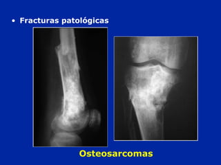 Osteosarcomas
• Fracturas patológicas
 