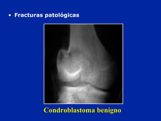Condroblastoma benignoCondroblastoma benigno
• Fracturas patológicas
 