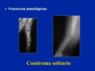 Condroma solitarioCondroma solitario
• Fracturas patológicas
 