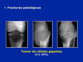 Tumor de células gigantes
(5 a 10%)
• Fracturas patológicas
 