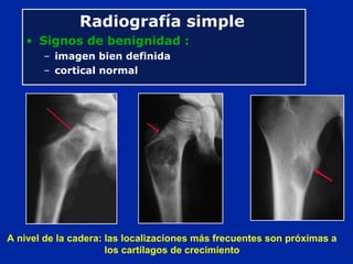 A nivel de la cadera: las localizaciones más frecuentes son próximas a
los cartílagos de crecimiento
Radiografía simple
• Signos de benignidad :
– imagen bien definida
– cortical normal
 