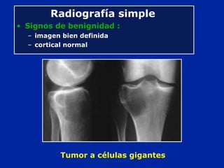 Radiografía simple
• Signos de benignidad :
– imagen bien definida
– cortical normal
Tumor a células gigantes
 