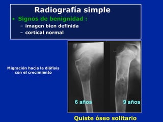 Radiografía simple
• Signos de benignidad :
– imagen bien definida
– cortical normal
Quiste óseo solitario
Migración hacia la diáfisis
con el crecimiento
6 años 9 años
 