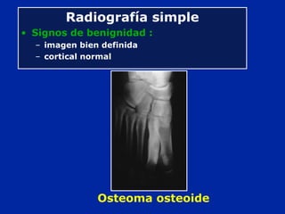 Osteoma osteoide
Radiografía simple
• Signos de benignidad :
– imagen bien definida
– cortical normal
 