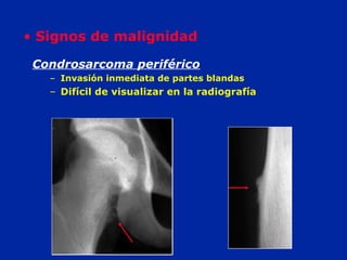 Condrosarcoma periférico
– Invasión inmediata de partes blandas
– Difícil de visualizar en la radiografía
• Signos de malignidad
 