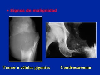 Tumor a células gigantesTumor a células gigantes CondrosarcomaCondrosarcoma
• Signos de malignidad
 