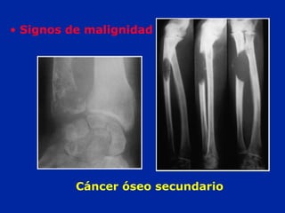 Cáncer óseo secundario
• Signos de malignidad
 