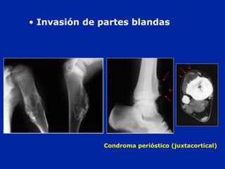 Condroma perióstico (juxtacortical)
• Invasión de partes blandas
 