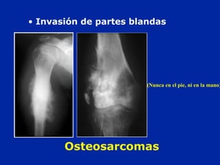 • Invasión de partes blandas
(Nunca en el pie, ni en la mano)
Osteosarcomas
 