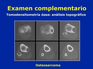 Tomodensitometría ósea: análisis topográfico
Osteosarcoma
Examen complementario
 
