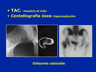 Osteoma osteoide
• TAC: muestra el nido
• Centellografía ósea: hipercaptación
 