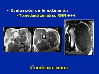 • Evaluación de la extensión
• Tomodensitometría, RMN +++
CondrosarcomaCondrosarcoma
 